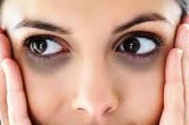 आँखों के नीचे काले घेरे अंडर आई डार्क सर्कल के उपाय - Under eye dark circle