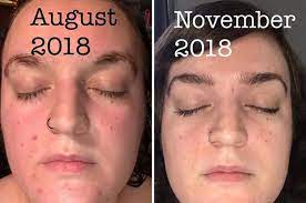 32 Cheap Skincare Products That Are All About Results Cheap Skin Care Products Uneven Skin Skincare For Oily Skin