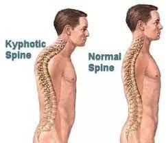 Do Squats Stunt Height Growth Quora