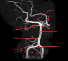 Image result for Posterior Circulation