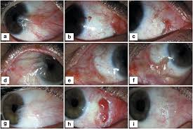 Check spelling or type a new query. Effects Of Intraoperative Steroid Injection On The Outcome Of Pterygium Surgery Eye