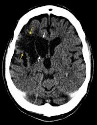 Bildergebnis für CVA