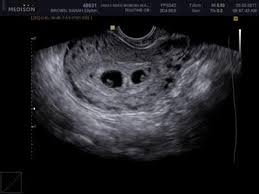 6 week ultrasound pictures twins. 200 Incredible Images Ideas In 2021 Ultrasound Ultrasound Pictures Twins Ultrasound