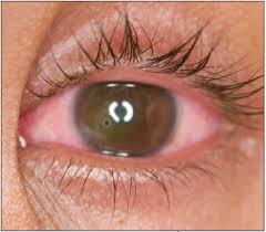 Image result for Eye Foreign Body
