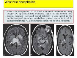 This patient went on to have hsv encephalitis proven on csf pcr. Imaging Of Viral Encephalitis