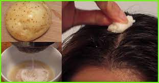 A typical hair transplant involves removing patches of hair from your head and reinserting the hair follicle by follicle into the bald sections. How To Use Potato Juice For Hair Growth