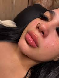 Any recommendation where to get lip filler ? And prices ?