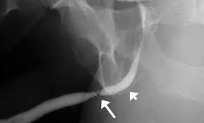 Image result for Retrograde Urethrogram