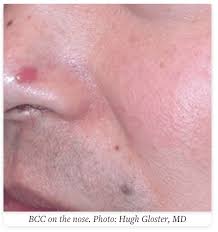 Image result for skin cancer on nose pimple