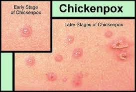 Penyakit ini disebabkan karena infeksi virus campak golongan paramixovirus. Panduan Dan Tips Kesihatan Vitamin Semulajadi