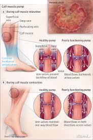 Venous Ulcers Of The Leg Occur Because The Veins Become Stretched Which Prevents The Valves In The Veins Wound Care Nursing Leg Ulcers Cardiovascular Nursing