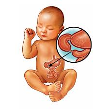 Image result for Intestinal Atresia