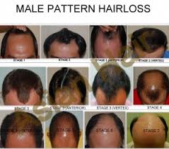 Minoxidil stimulates your hair follicles and slows down hair loss for many men. Androgenic Alopecia Best Treatment Options Dr Julieta Arambulo
