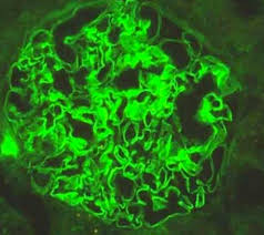 Whe possible, employ direct immunofluorescence. Nephritic Syndrome Renal Medbullets Step 1