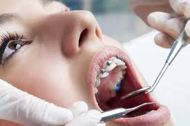 We did not find results for: Should I Visit My Dentist While I Wear Braces Orthodontic Associates