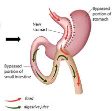 With Gastric Bypass At Bariatric Mexico Surgery Patients Can Lose An Average Of Up To 80 Percent Of Their Gastric Bypass Surgery Bypass Surgery Gastric Bypass