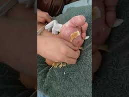 Sunburns will emphasise this phenomenon, leading to dead cells detaching from your skin in larger. Peeling Foot After Cast Has Been Removed Youtube