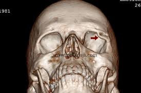 Check spelling or type a new query. Balaji Dental And Craniofacial Hospital Dr S M Balaji Maxillofacial Surgeron India Best Dental Clinic In Chennai Best Dental Implant Center In India