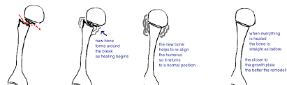 Image result for Humerus Growth Plates