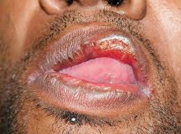 Image result for Secondary Syphilis