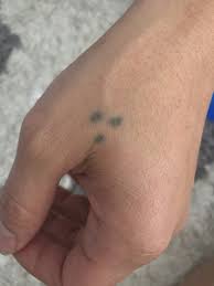 Often seen on the face of the latinx gang member in movies and television shows, the three dot tattoo design has earned a big meaning in. This 3 Dot Tattoo Is In The Processing Of Removal Via Glycolic Acid Post 2 Weeks Does This Tattoo Look Infected Photo