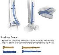 Distal tibial nail is a new technology for distal tibial ...