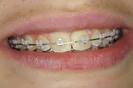 Bagues Dentaires En Ceramique Orthodontiste A Lyon 3 Dr Pagliano Fabienne