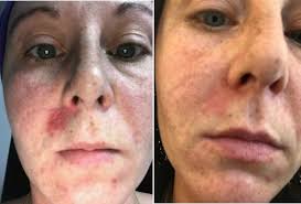 Dry Face Skin Symptoms And Remedy In 2020 Dry Skin On Face Dry Face Face Skin