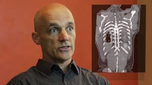 Bicycle Accident ~ Tim Lovett's Testimony