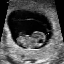 Week 8 Ultrasound What It Would Look Like Ultrasound Pictures Ultrasound Sonogram Pictures