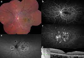 Apmppe is an inflammatory disease of the retina and choroid, tissues that line the back of the eye, much like the film in a camera. Multimodal Imaging Of Apmppe Related Disorders