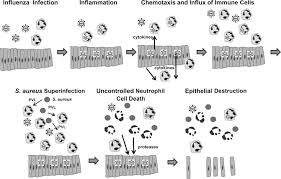 Pvl positive staphylococcus aureus often cause recurrent and severe skin and soft tissue. Combined Action Of Influenza Virus And Staphylococcus Aureus Panton Valentine Leukocidin Provokes Severe Lung Epithelium Damage Abstract Europe Pmc