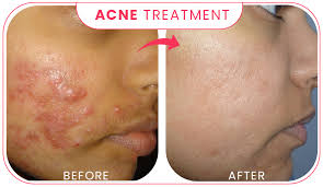 We considered customers' reviews, skin care finished projects and their closeness to you. Find Best Dermatologist And Skin Specialist Doctor In India Sakhiya Skin Clinic