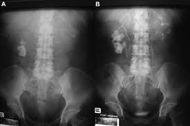 A Double Collecting System Of Right Kidney With Staghorn Calculi In Download Scientific Diagram