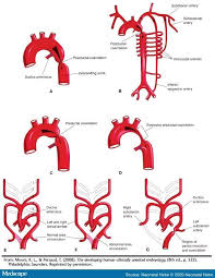 Cardiology For You Aortic Arch Anomalies In 2020 Coarctation Of The Aorta Diagnostic Medical Sonography Aortic Stenosis
