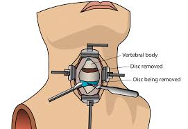 Benefits of spinal fusion surgery. Anterior Cervical Discectomy Acdf Surgery All You Need To Know