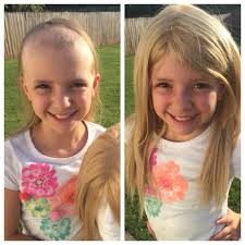 Hereditary hair loss with age is the most common cause of baldness. A Post From A Parent Of A Children With Hair Loss Facebook