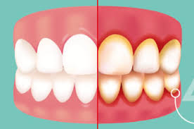 2.1 what to do if you have painful or bleeding gums. Gingivitis Symptoms Potential Causes Chesterfield Family Dentistry
