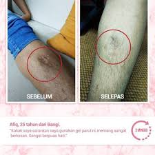 Selain parut luka, anda juga boleh menggunakannya untuk memudarkan parut jerawat pada muka. Tips Cara Hilangkan Parut Cara Mudah Dan Berkesan Berita Viral