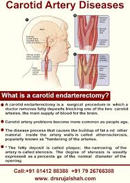 Carotid Endarterectomy Is A Surgical Procedure Used To Reduce The Risk Of Stroke By Correcting Stenosis Carotid Artery Vascular Surgery Internal Carotid Artery