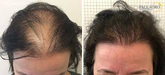 Trapianto di capelli senza rasatura. Trapianto Capelli Donna Differenza Tecnica Costo Clinica Pallaoro