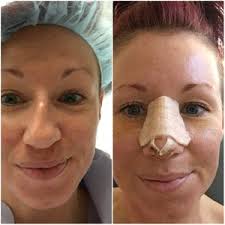 Krista Lee Olson, MD, Board Certified Facial Plastic Surgeon