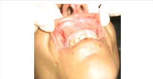 Bruising In The Internal Face Of The Upper Lip In Case 1 Download Scientific Diagram Face bruise, scratches, red png clipart. internal face of the upper lip in case