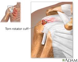 Know the anatomy of the shoulder involving its skeletal system, cartilages, ligaments, muscles, tendons. Rotator Cuff Problems Medlineplus Medical Encyclopedia