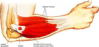 Then twist your fist out so your palm is facing out to the side and you feel a stretch. 6 Steps To Fixing Tennis Elbow Pain Sport Spinal Physiotherapy