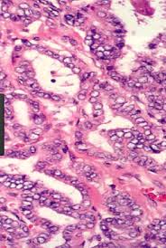 Medullary carcinoma of thyroid, 3.anaplastic carcinoma of thyroid, 4. Histology Adrenal And Thyroid Gland Pathology Flashcards Quizlet