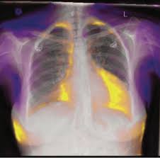 Andrew Dixon On Twitter And Here S A Gif Of A Normal X Ray Being Converted To Heart Failure By The Model Note How It Adds A Big Heart Some Pleural Fluid In The Congestive heart failure (chf) is the result of insufficient output because of cardiac failure, high resistance in the circulation or fluid overload. gif of a normal x ray