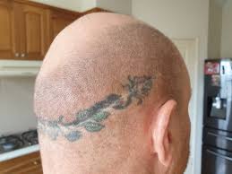 If the nerves are ok or damaged? Tattoo Over Scar Not Smp Hair Loss Forum Hair Transplant Forums