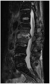 Image result for Spinal Infection