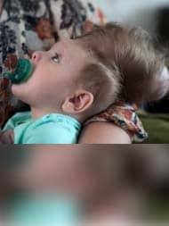 We Had No Hope': The Amazing Story Of The Baby Born With His Brain Outside  His Skull